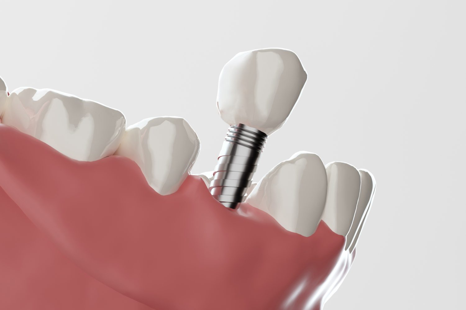 インプラントのサージカルガイド費用はいくら？メリット・デメリットや治療の流れを解説