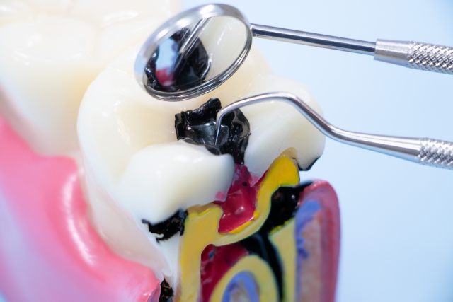 むし歯放置による治療面へのリスク