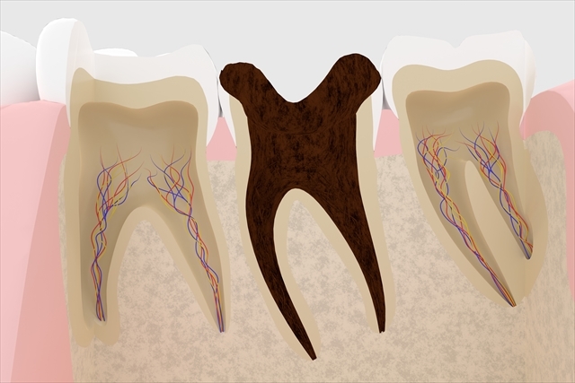 根管治療とは
