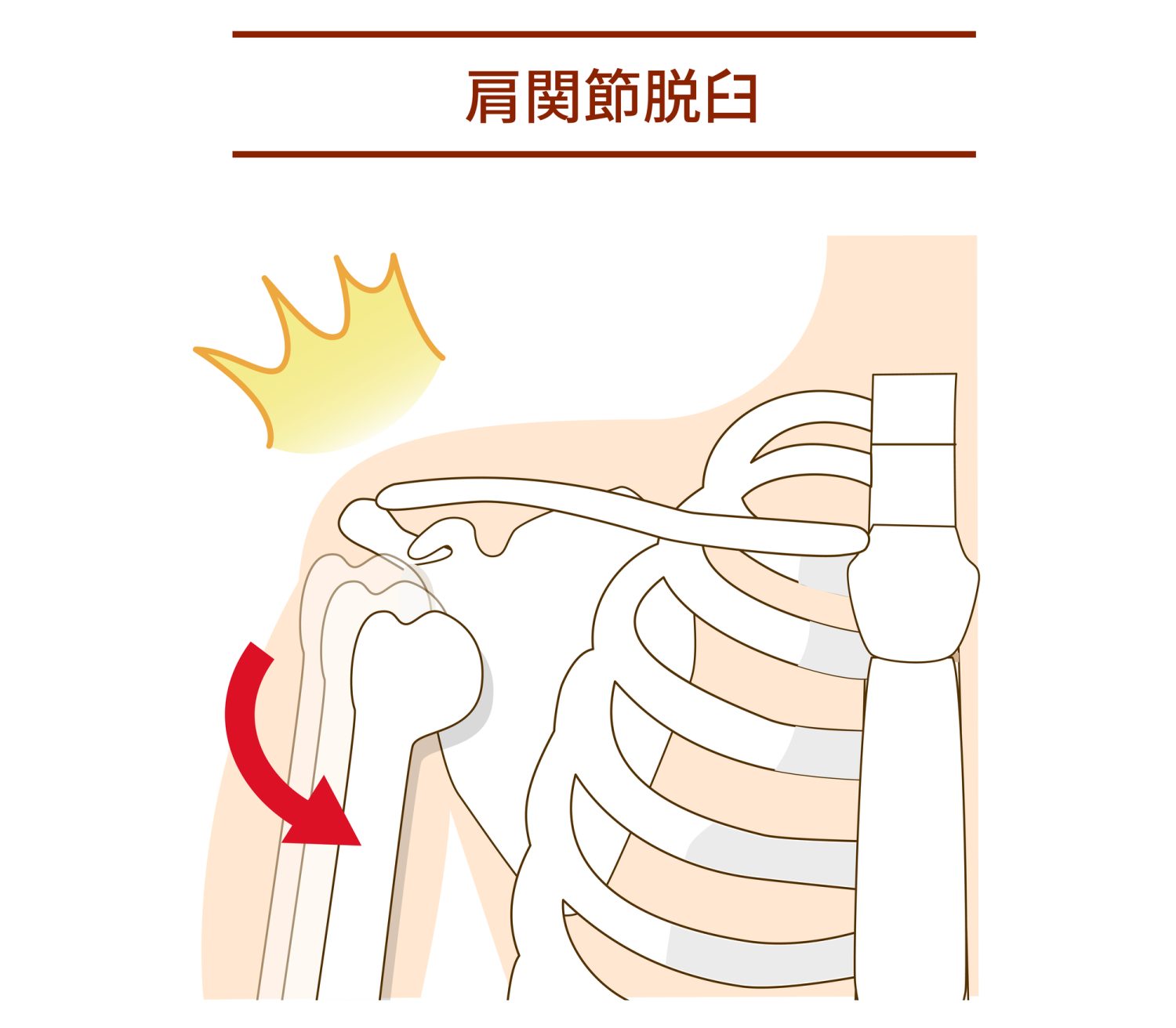 肩関節の脱臼はなぜ起こる？