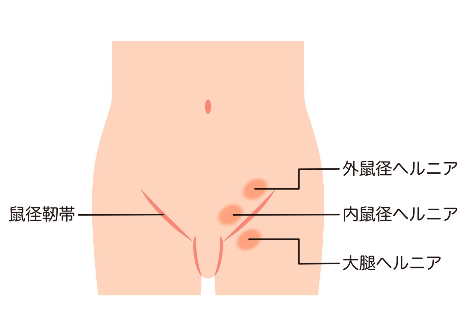 鼠径ヘルニアはなぜ起きる？