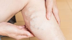 『下肢静脈瘤』はどう治す？ 日帰り手術や負担の少ない治療法【医師解説】