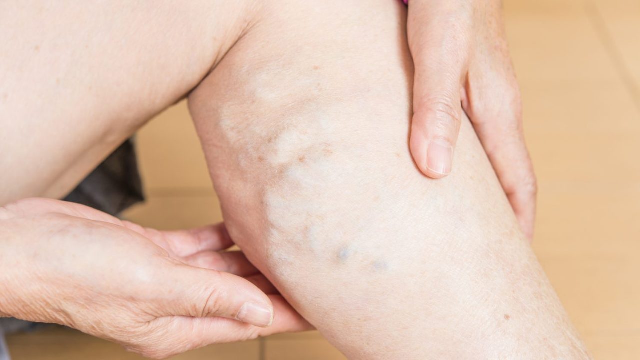 『下肢静脈瘤』はどう治す？ 日帰り手術や負担の少ない治療法【医師解説】