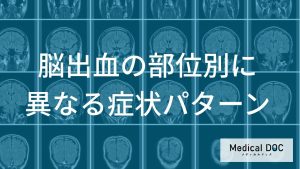 脳出血の部位別に異なる症状パターン