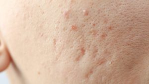 『クレーター状のニキビ跡』は治る？ サブシジョン治療と注意点【医師解説】