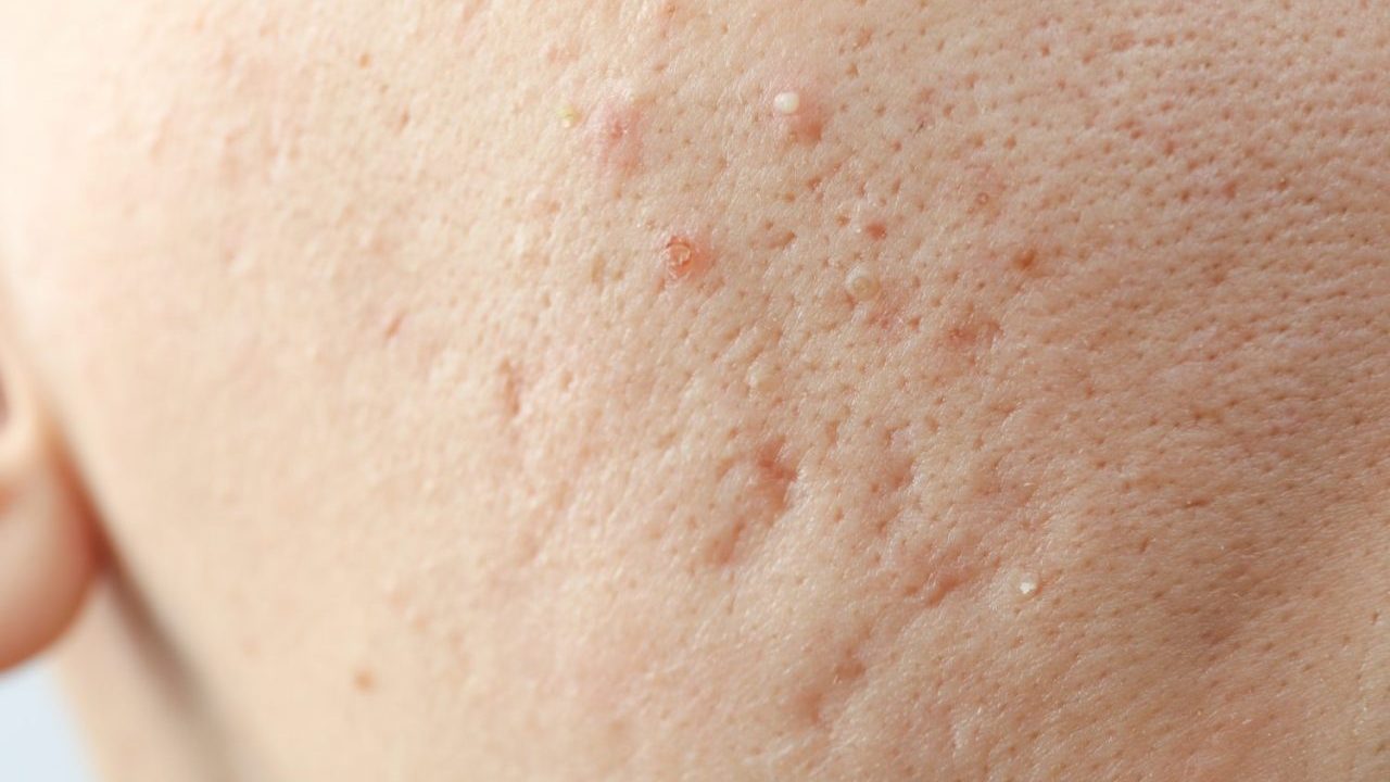 『クレーター状のニキビ跡』は治る？ サブシジョン治療と注意点【医師解説】