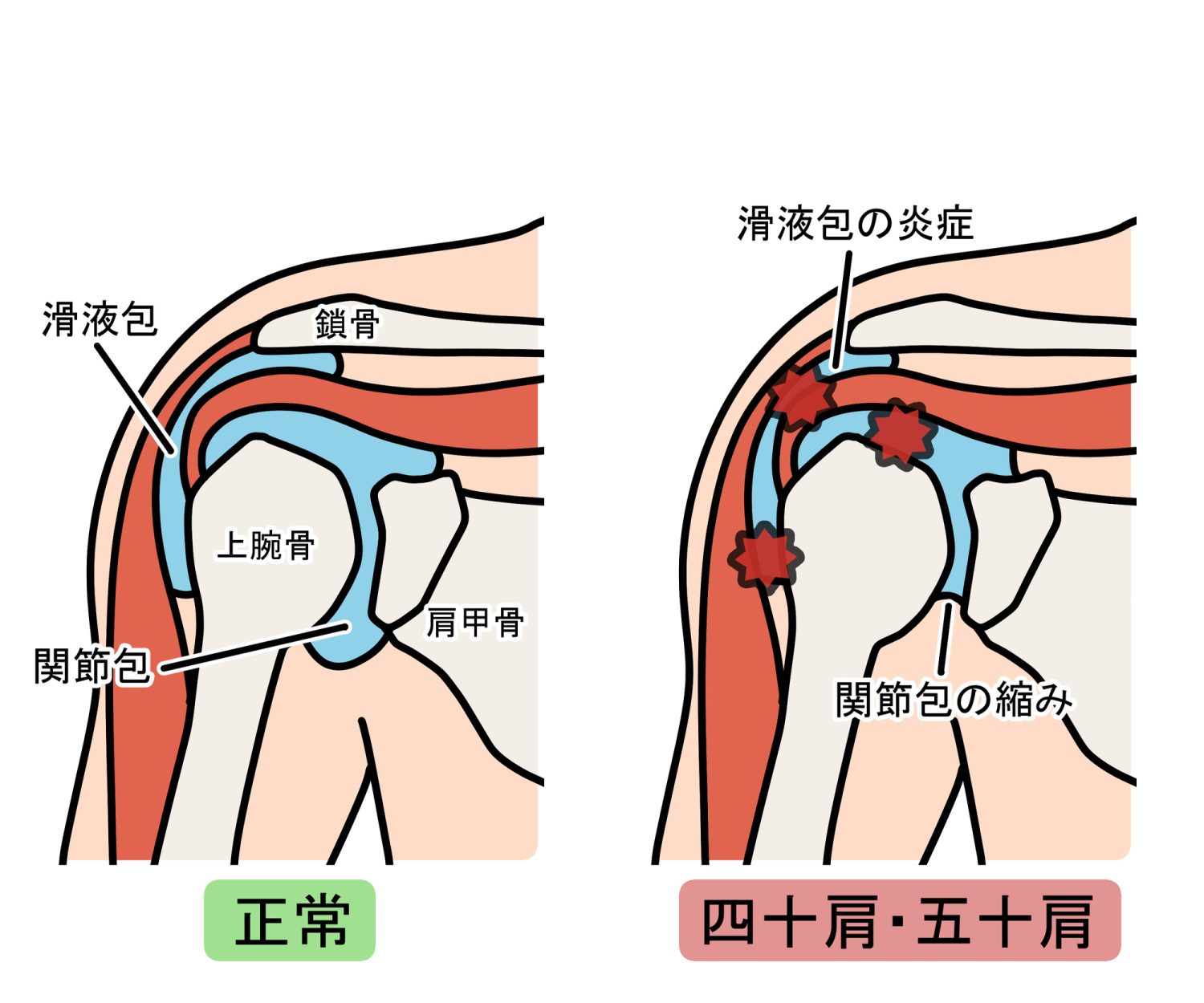 四十肩・五十肩の基本情報