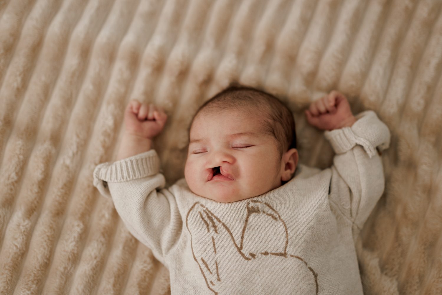 口唇口蓋裂の基礎知識と歯への影響