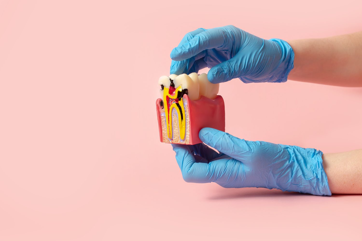 歯列矯正中にむし歯ができる理由