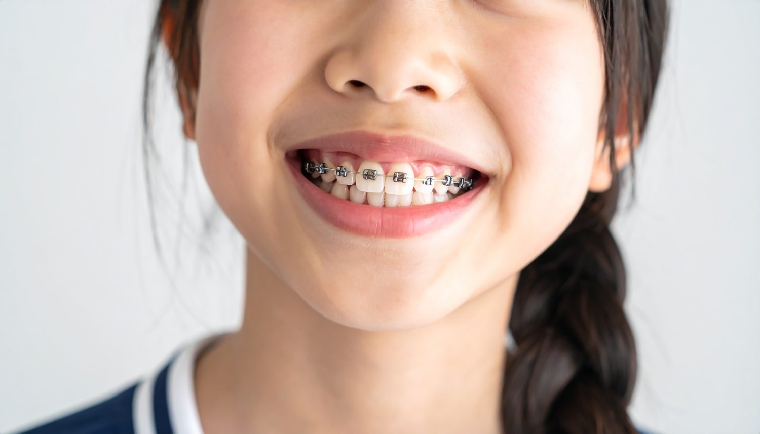 【成長段階別】口唇口蓋裂の歯列矯正治療の流れ