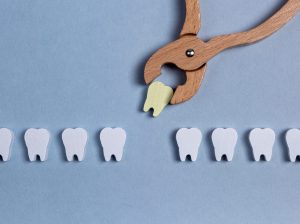 歯列矯正中にむし歯が見つかった場合は抜歯が必要？治療の流れや対処法を解説