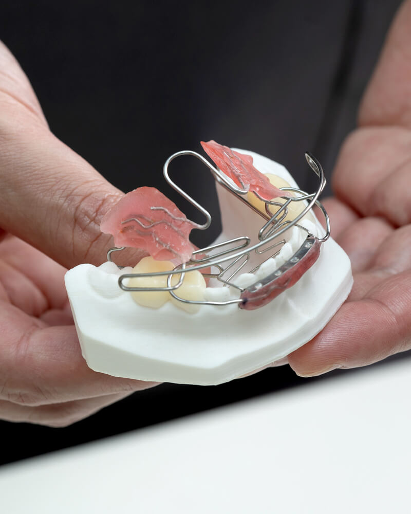 舌の癖が歯並びに影響？ ネオキャップシステムが改善効果を発揮