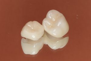 CAD/CAM冠は奥歯でも保険適用できる？条件や費用、注意点を解説