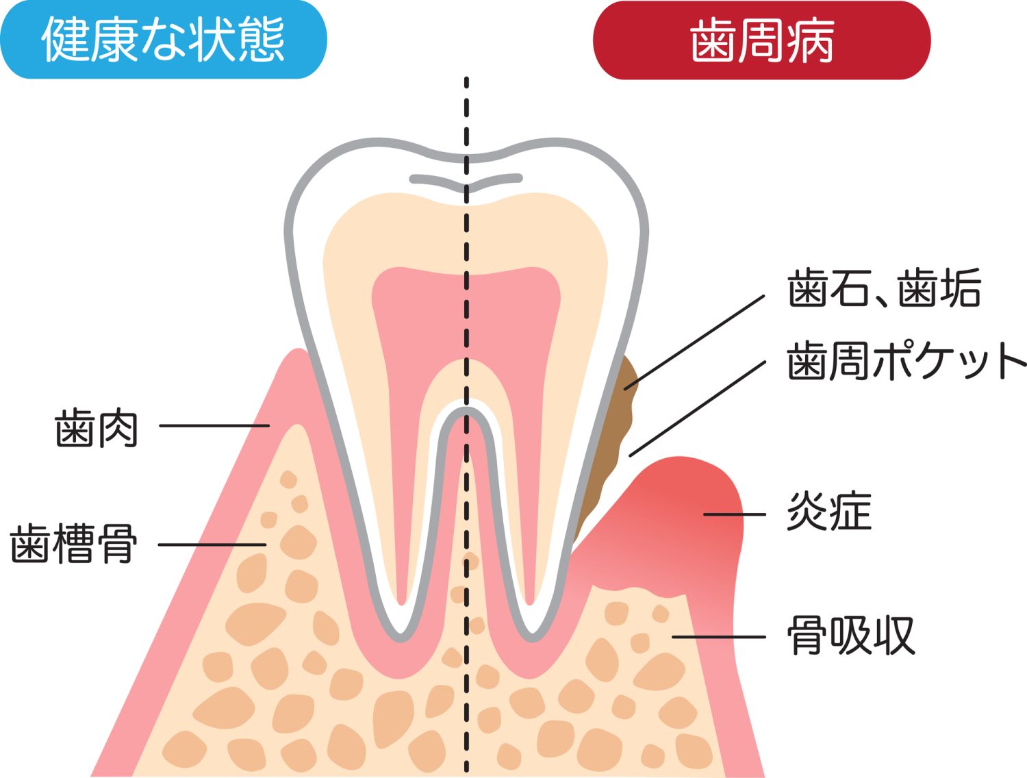 歯周病の「進行度別」に見る矯正治療のポイント