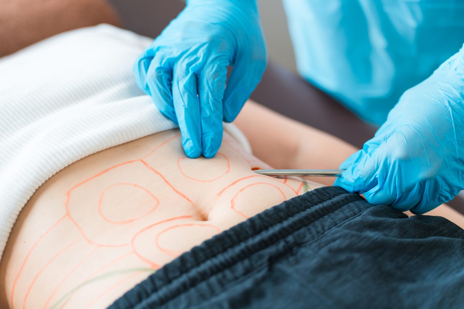 脂肪吸引、部位別の特徴が知りたい