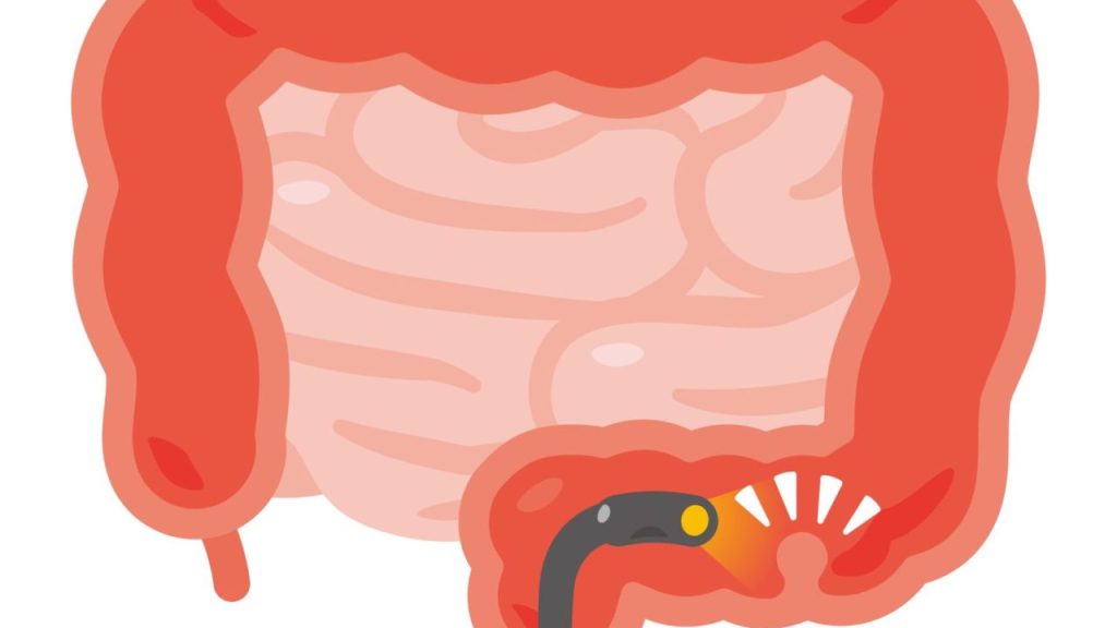 『大腸ポリープ』ができやすい人の特徴 「がん」のリスクや治療の流れも医師が解説