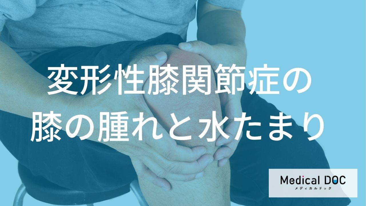 膝の腫れが数日続くときは要注意？ 「変形性膝関節症」が疑われるサインと受診の目安を解説