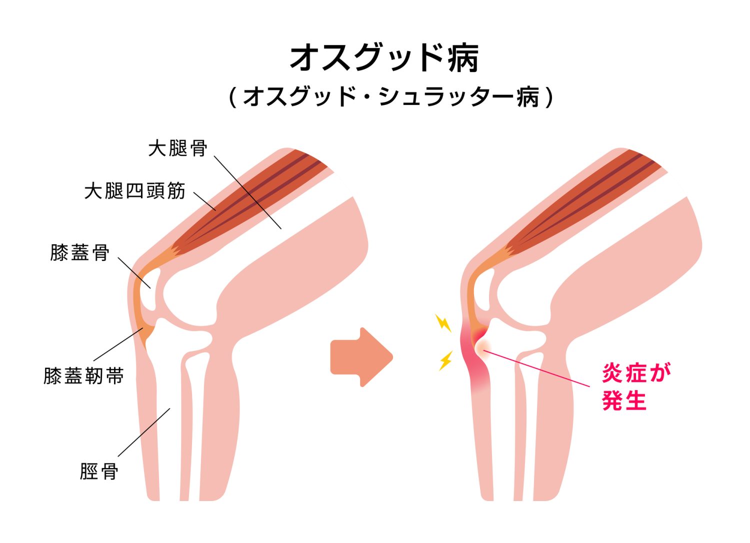 成長痛とどう違う？ まず知っておきたい基礎知識