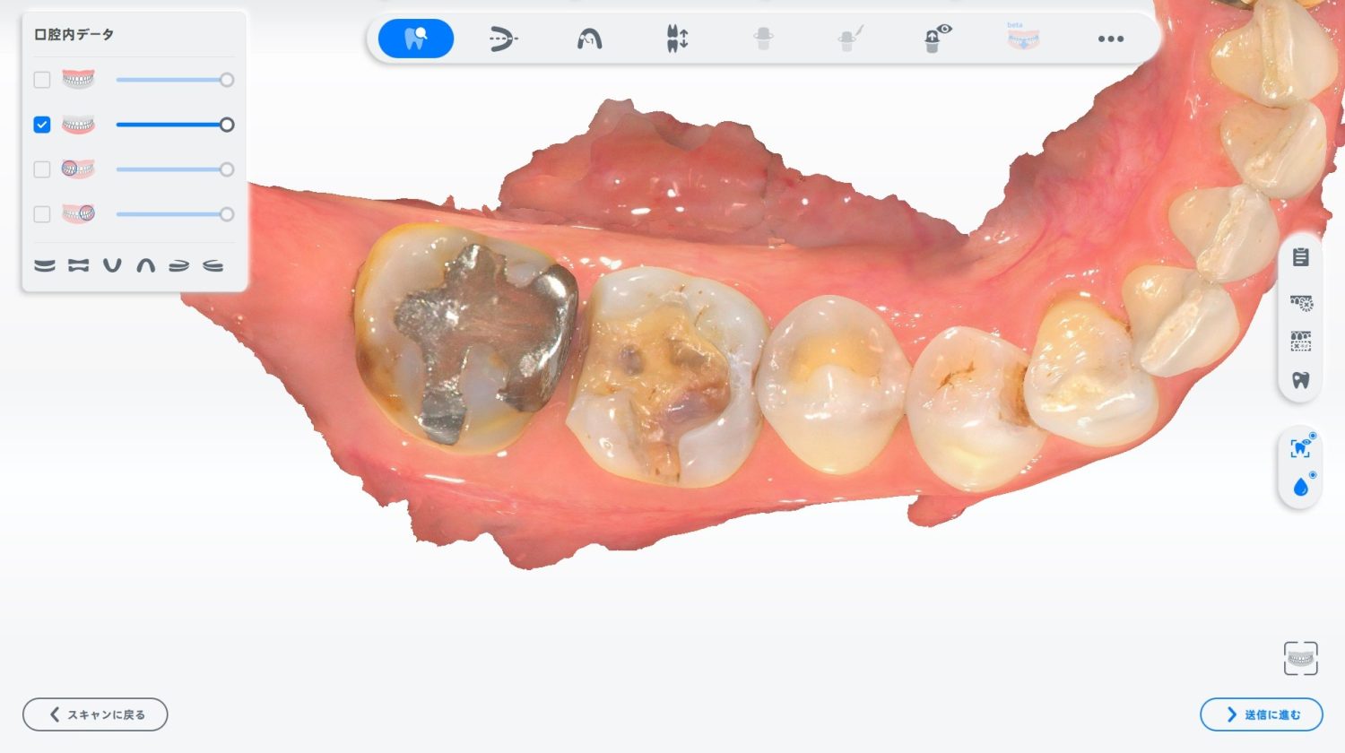型どり不要のCAD/CAMインレー（白い詰め物）の症例紹介①（山口歯科医院）-治療中