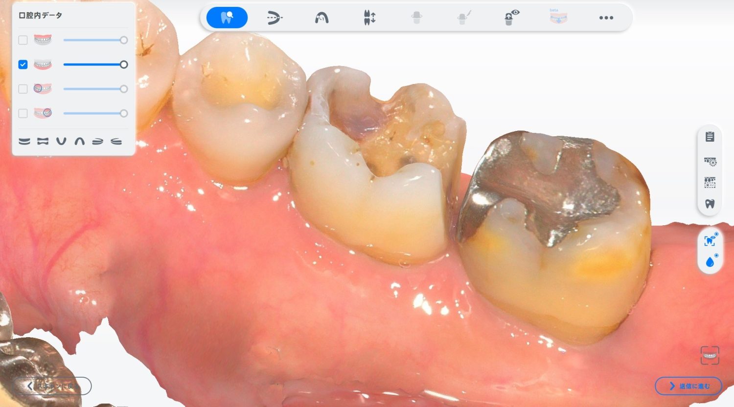 型どり不要のCAD/CAMインレー（白い詰め物）の症例紹介①（山口歯科医院）-before