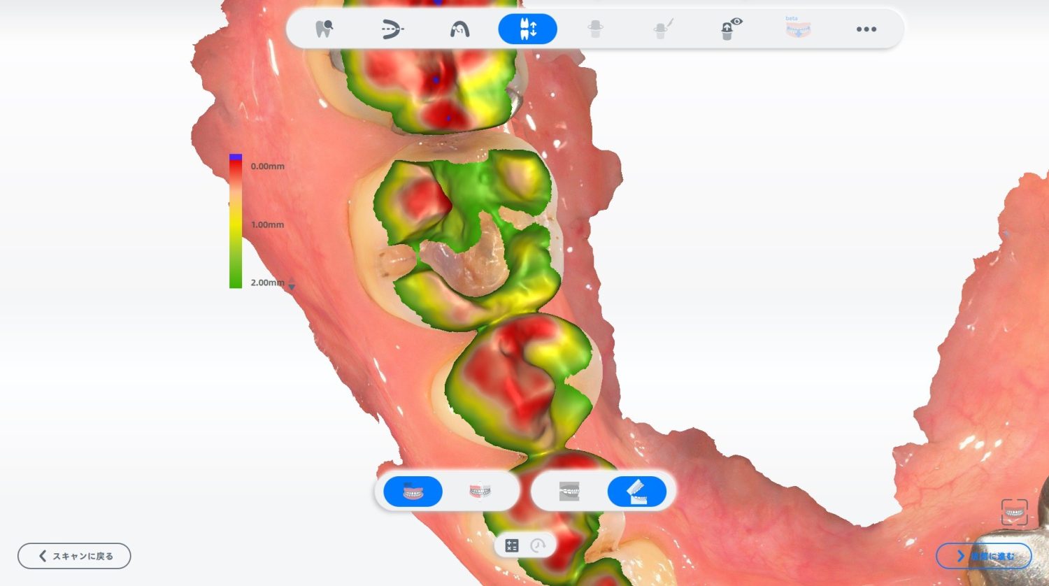 型どり不要のCAD/CAMインレー（白い詰め物）の症例紹介①（山口歯科医院）-治療中
