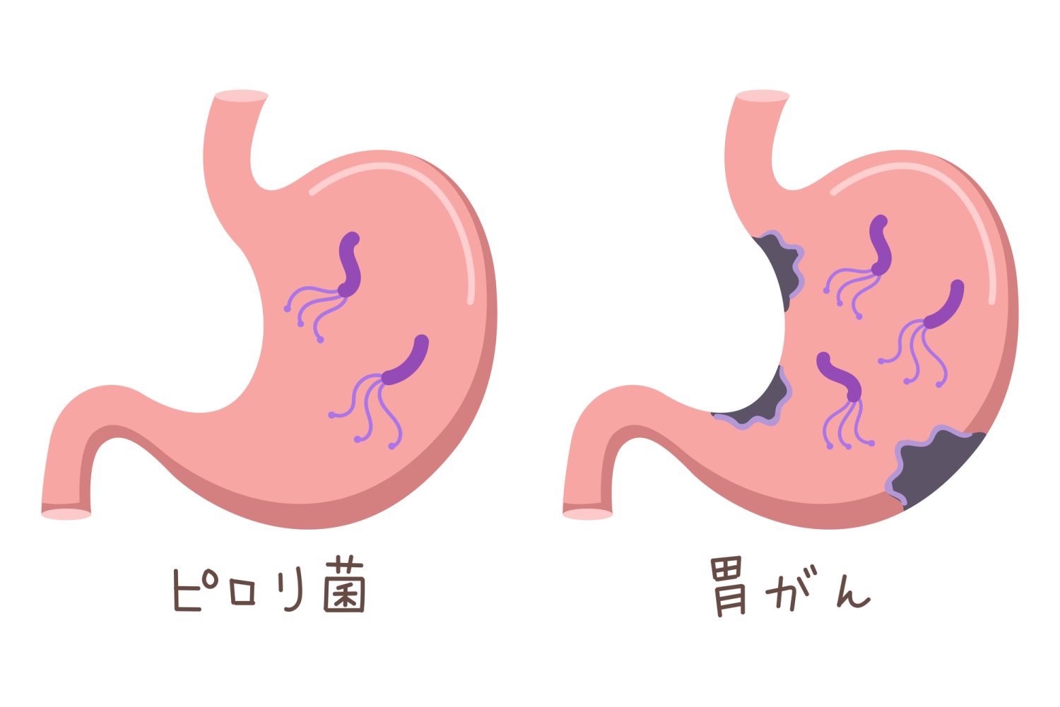 ピロリ菌と胃がんの関係