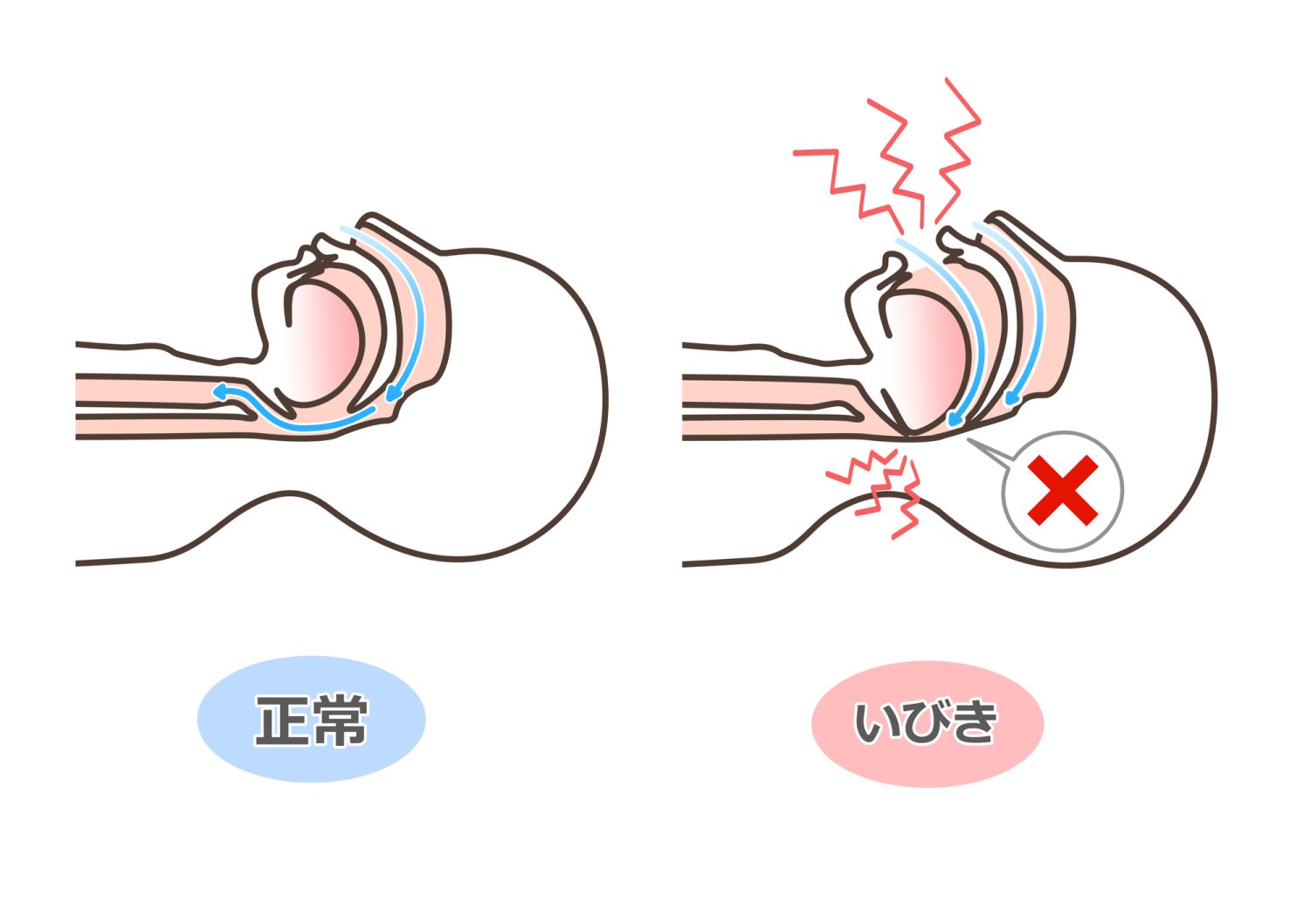 いびきは「音」ではなく体の異常サイン