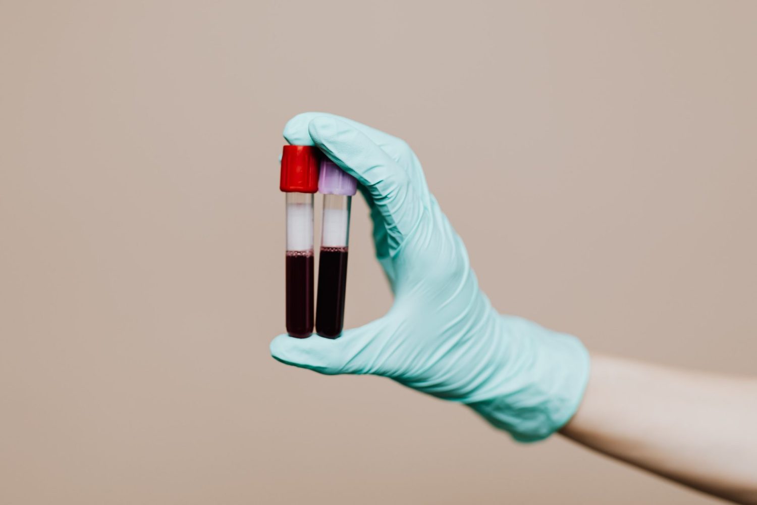 強皮症の診断と治療