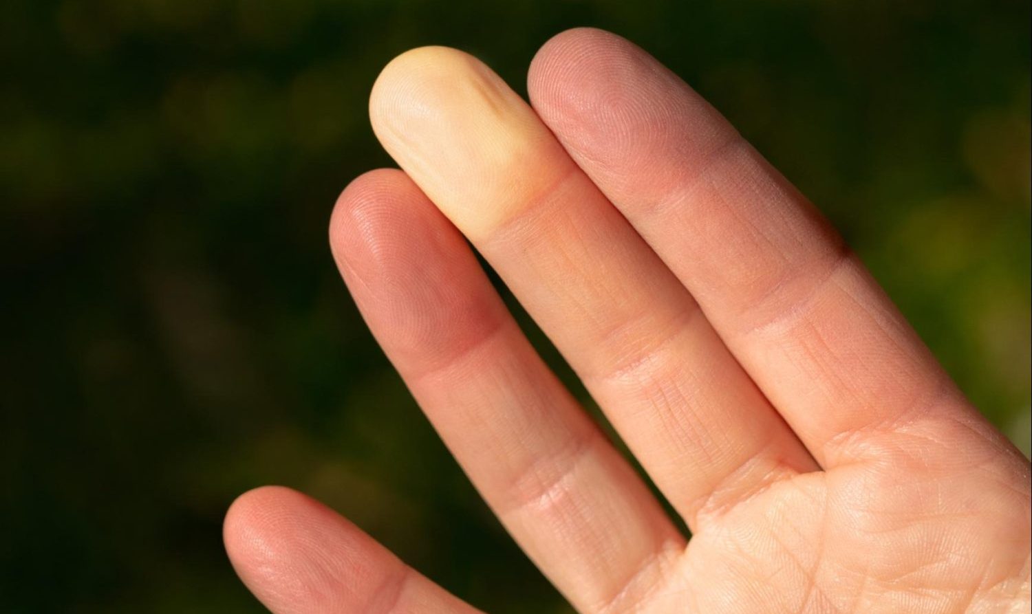 全身性強皮症の基礎知識