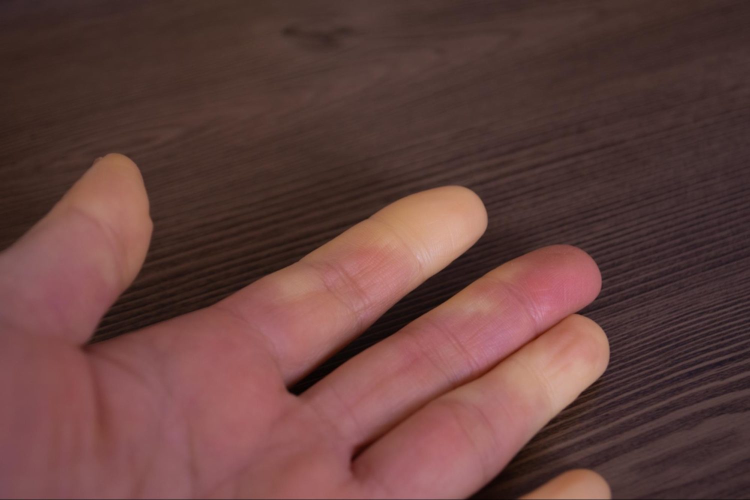 膠原病の皮膚症状｜見た目の特徴