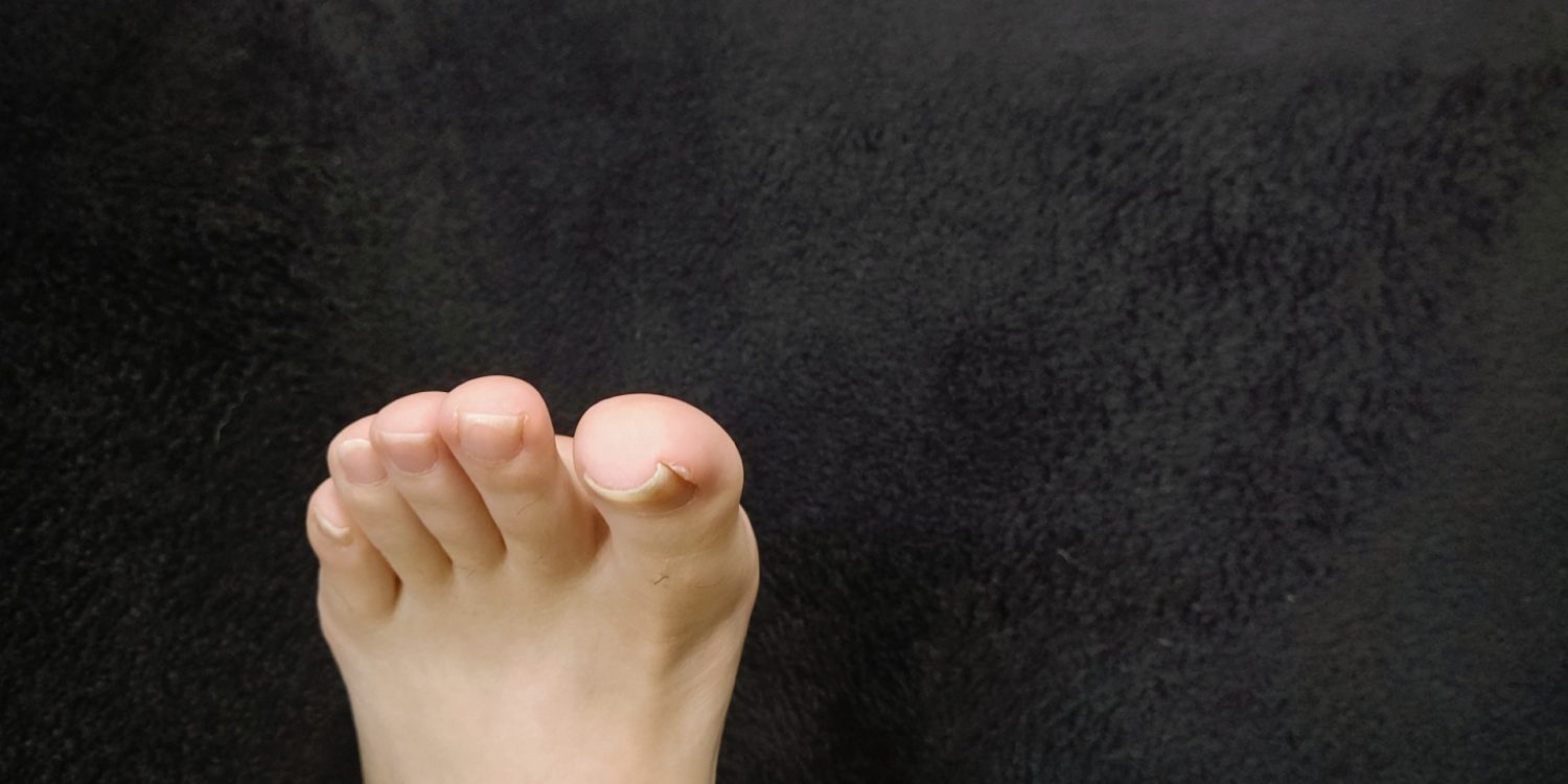 巻き爪の症状や特徴