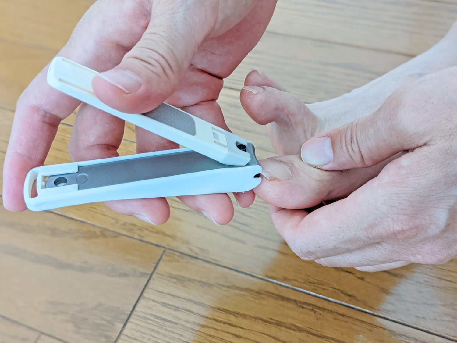 巻き爪の治療と対処法