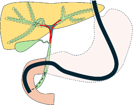 肝門部胆管がんの検査法_内視鏡的逆行性胆管膵管造影（ERCP）