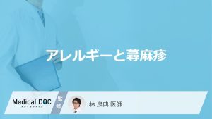 「アレルギーによる蕁麻疹」の特徴はご存知ですか？対処法や受診の目安も解説！