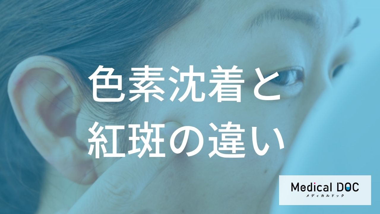 「発疹」後の赤みの“見逃し”には注意？ 跡が残る色素沈着の落とし穴【医師監修】