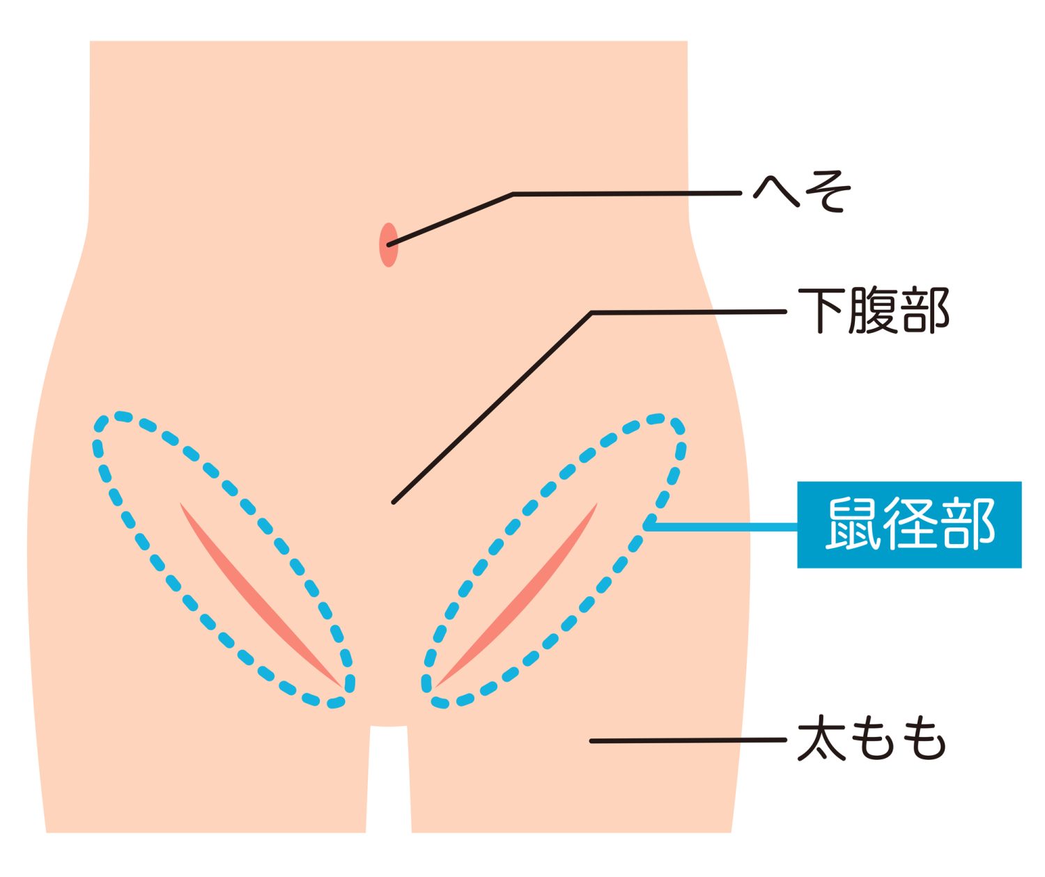 この症状があったら鼠径ヘルニアかも？