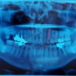 歯周病とレントゲンの関係について