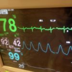 心房細動の症状や原因、治療法とは？