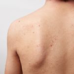 アトピー治療においてステロイド剤の有効性は？ それ以外の治療ってどうなの？