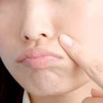 尋常性ざ瘡（にきび）の症状や原因、治療方法とは？