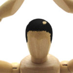 円形脱毛症の症状や原因、治療法とは？