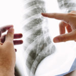 転移性肺がんの症状・原因・治療方法についてご案内