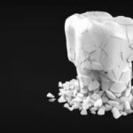 従来型とは何が違うの？顕微鏡治療による虫歯へのアプローチ